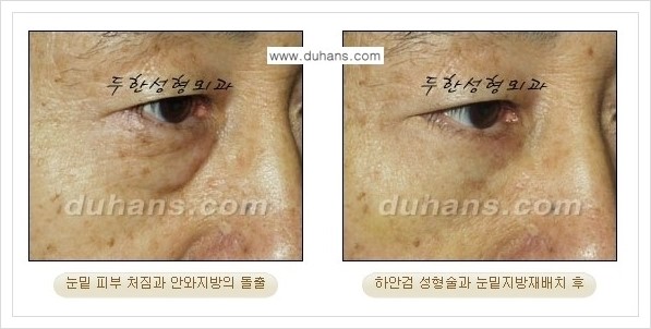 [두한성형외과 경쟁력 눈성형] - [젊은 눈매로의 복원 안검성형] 관련 이미지 33