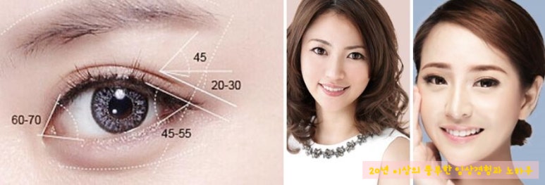 [두한성형외과 쌍커풀 재수술]  - [극한 눈재수술] 관련 이미지 46