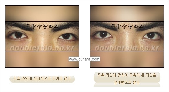 [두한성형외과 경쟁력 쌍꺼풀 재수술] - [비대칭(짝짝이) 쌍꺼풀 라인 교정하는 방법 안내 ①] 관련 이미지 8