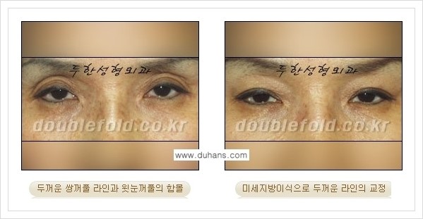 [두한성형외과 경쟁력 눈성형] - [미세지방이식으로 두껍고 어색한 라인 교정 안내 1.] 관련 이미지 8
