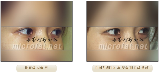 [두한성형외과 지방이식] - [다크써클, 눈​밑주름] 관련 이미지 44
