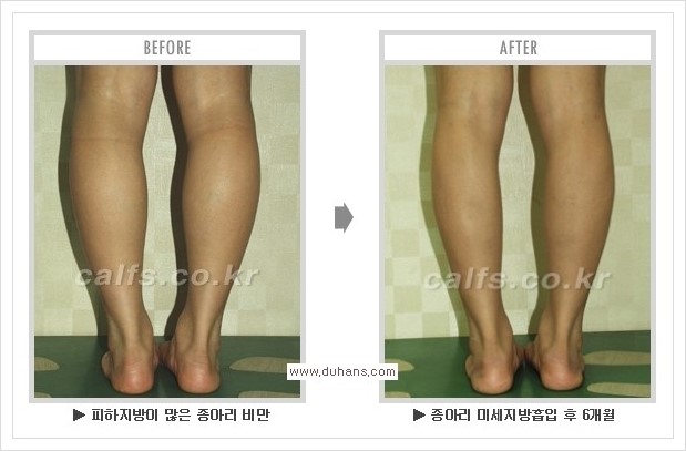 [두한성형외과 경쟁력 멀티종아리성형] - [종아리성형 방법별 전후 주의사항] 관련 이미지 23