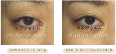 두한성형외과 눈재수술 - 쌍꺼풀 재수술 방법 관련 이미지 16