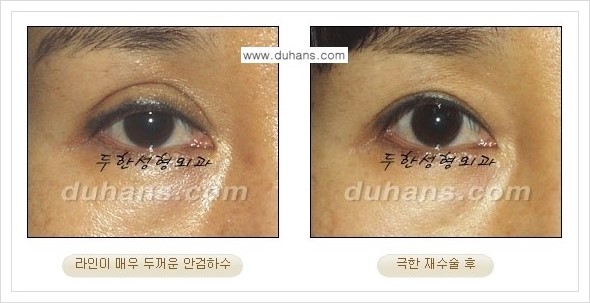 [두한성형외과 경쟁력 망가진 눈 복원수술] - [두꺼운 라인을 교정하는 극한 재수술(Extreme Reoperation) 안내] 관련 이미지 13