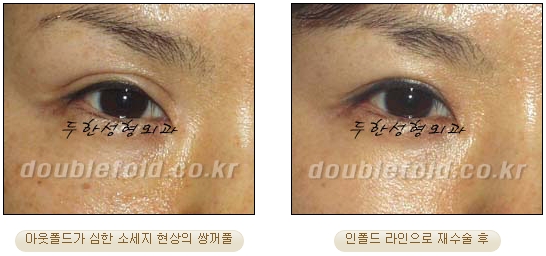 쌍꺼풀수술 두한성형외과 - 쌍커풀재수술의 문제점 관련 이미지 5