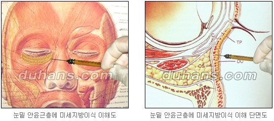 두한성형외과 눈밑성형 - 눈밑지방제거, 눈밑주름, 눈밑지방재배치 관련 이미지 59