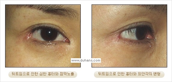 [두한성형외과 경쟁력 쌍꺼풀 재수술, 극한 눈재수술] - [뒤트임 수술의 부작용 안내] 관련 이미지 10