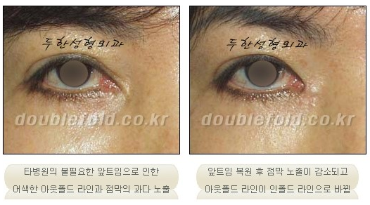 [Dohan Plastic Surgery Double Eyelid Surgery] - [Beautiful Double Eyelids] image 12
