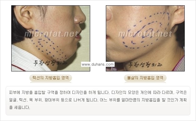 [두한성형외과 경쟁력 지방흡입] - [얼굴 지방흡입 부작용 교정방법 안내] 관련 이미지 7