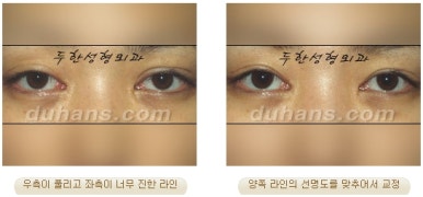 두한성형외과 눈재수술 - 쌍꺼풀 재수술 방법 관련 이미지 10