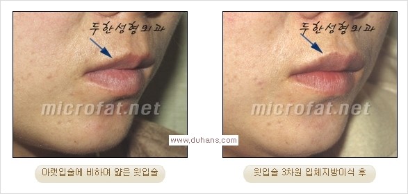 [두한성형외과 경쟁력 미세지방이식] - [입술 3차원 입체지방이식 안내 2.] 관련 이미지 3