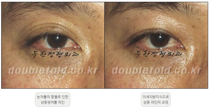 [쌍꺼풀수술 두한성형외과] - [재수술 방법들] 관련 이미지 28