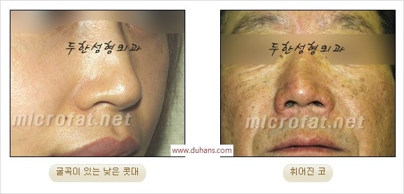 [두한성형외과 경쟁력 코성형 리더] - [자연스럽고 오똑한 콧망울! 코성형 방법]​ 관련 이미지 40