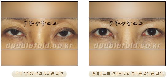 [Duhan Plastic Surgery Secondary Double Eyelid Surgery] - [Sleepy Eye Appearance, Asymmetrical Eye Appearance, Ptosis] image 20