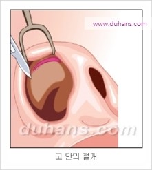 [두한성형외과 경쟁력 코성형 리더] - [자연스럽고 오똑한 콧망울! 코성형 방법]​ 관련 이미지 3
