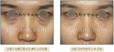 두한성형외과 눈밑성형 - 눈밑지방제거, 눈밑주름, 눈밑지방재배치 관련 이미지 62