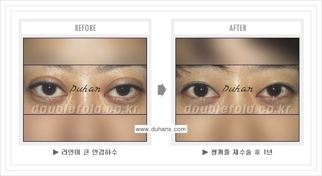 [두한성형외과 경쟁력 쌍꺼풀 재수술, 극한 재수술] - [여러번의 재수술로 인해 흉살이 두터운 경우 교정 방법 안내] 관련 이미지 3