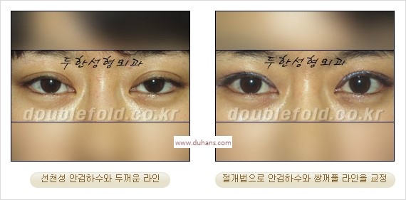 ⁠⁠[두한성형외과 경﻿쟁력 쌍꺼풀 재수술] - [안검하수(졸리운 눈매) 종류와 교정 방법 안내] 관련 이미지 30