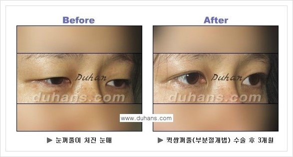 [두한성형외과 경쟁력 쌍꺼풀 재수술, 극한 재수술] - [퀵쌍꺼풀 안내] 관련 이미지 24