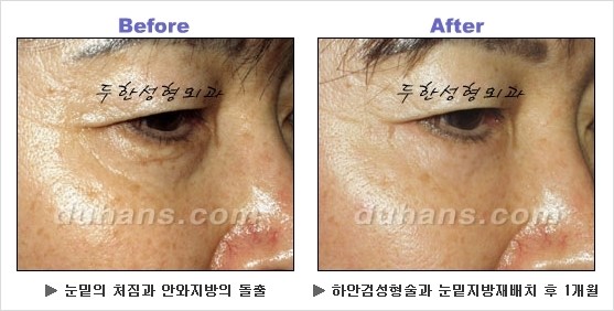 [두한성형외과 경쟁력 동안성형 리더] - ​[미간주름, 이마주름, 안검성형, 이마거상술, 눈썹거상술] 관련 이미지 77