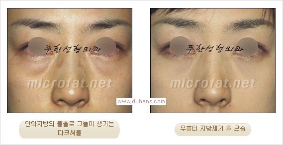 ⁠⁠[두한성형외과 경쟁력 안검성형] - [젊은 눈매를 위한 윗눈꺼풀 지방제거, 눈밑 지방제거] 관련 이미지 21