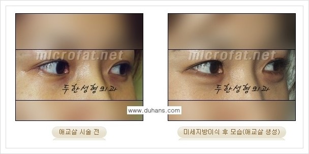 [두한성형외과 경쟁력 눈밑성형] - [눈밑 애교살 시술을 위한 미세지방이식] 관련 이미지 6