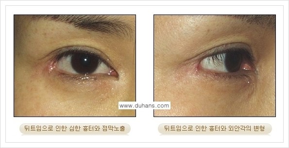 [두한성형외과 경쟁력 쌍꺼풀 재수술, 극한 눈재수술] - [뒤트임 수술의 부작용 및 교정 방법 안내] 관련 이미지 10