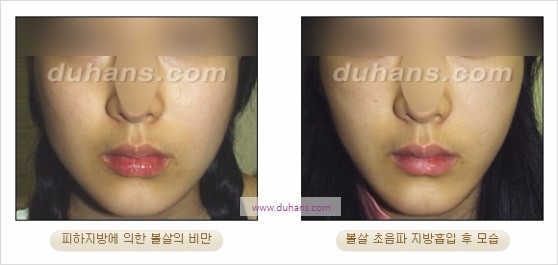 [두한성형외과 경쟁력 지방흡입] - [볼살, 턱선의 간편 지방흡입] 관련 이미지 11