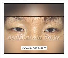 [두한성형외과 경쟁력 쌍꺼풀 재수술] - [쌍꺼풀 재수술의 대상과 해당 쌍꺼풀 재수술 방법 안내] 관련 이미지 5