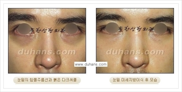 [두한성형외과 경쟁력 눈밑성형] - [꺼진 눈밑, 눈밑 함몰 주름선 눈밑 미세지방이식 안내] 관련 이미지 19