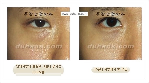 [두한성형외과 경쟁력 안검성형] - [눈밑 지방제거 안내] 관련 이미지 11