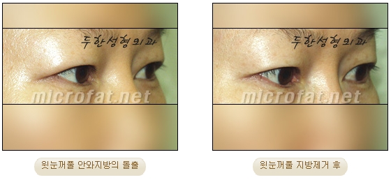 [두한성형외과 지방제거] - [눈밑지방제거, 윗눈꺼풀지방제거] 관련 이미지 61