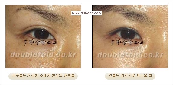 [두한성형외과 경쟁력 쌍꺼풀 재수술, 극한 재수술] - [쌍꺼풀 재수술에서 극복해야 할 극한의 상황과 문제들] 관련 이미지 8