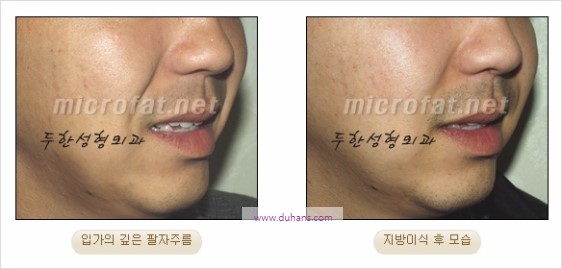 [두한성형외과 경쟁력 주름성형] - [젊어 보이는 입가팔자주름 지방이식] 관련 이미지 18