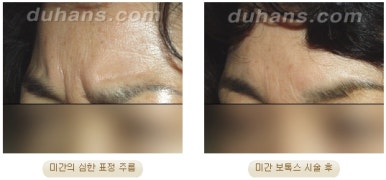 [Wrinkle Correction, Duhan Plastic Surgery] - [Wrinkle Botox, Wrinkle Filler, Wrinkle Fat Grafting] image 9