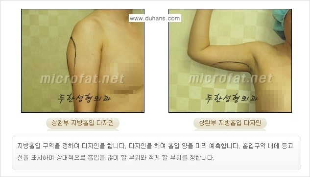 [두한성형외과 간편 지방흡입] - [복부(뱃살) 지방흡입 안내 ②] 관련 이미지 4