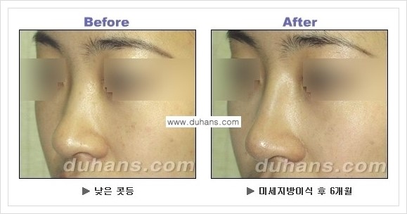 [두한성형외과 경쟁력 코성형] - [코높힘 미세지방이식 정보 안내] 관련 이미지 9