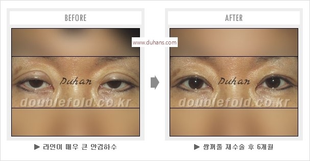 [두한성형외과 경쟁력 눈성형] - [나에게 맞는 어울리는 쌍꺼풀 라인] 관련 이미지 10