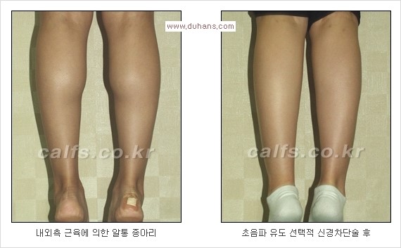 [두한성형외과 Dr. 컬럼] - [종아리 근육퇴축술로 가장 선호하는 비절개 초음파 유도 선택적 신경차단술] 관련 이미지 5