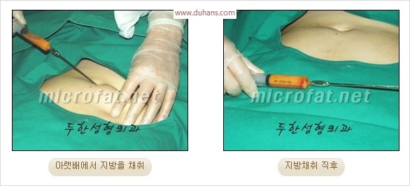 [두한성형외과 경쟁력 눈성형 리더] - [윗눈꺼풀 함몰( #꺼진눈꺼풀) 미세지방이식과 상안검성형]#꺼진눈성형 , #눈위함몰 관련 이미지 5