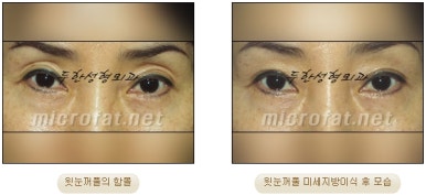 [Doohan Plastic Surgery Autologous Fat Grafting] - [Sunken Eye Fat Grafting] image 12