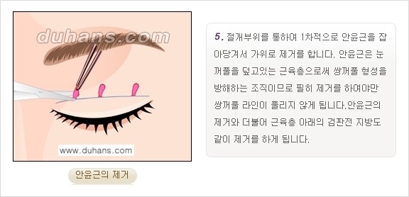 [두한성형외과 경쟁력 눈성형] - [쌍꺼풀 재수술 방법 - 부분절개법(Partial incision method) 과정 안내] 관련 이미지 6