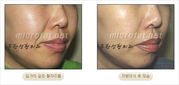 [두한성형외과 경쟁력 안티에이징 동안성형] - [주름이 깊은 푹~ 꺼진 입가 팔자주름 안녕!] 관련 이미지 27