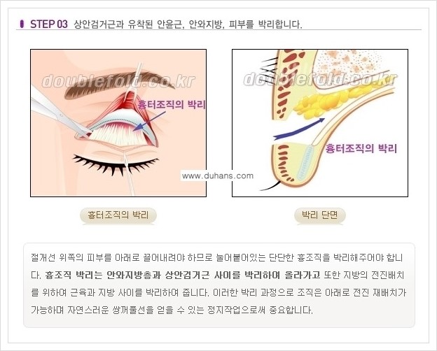 [두한성형외과 경쟁력 쌍꺼풀 재수술, 극한 재수술] - [쌍꺼풀 재수술의 과정 안내 1.] 관련 이미지 3