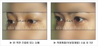 Best Place for Double Eyelid Revision Surgery, Duhan Plastic Surgery - Partial Incision Eye Revision Surgery image 20