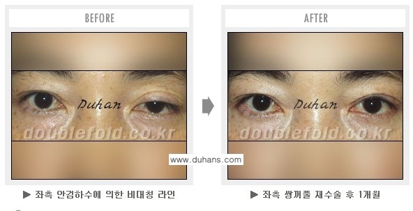 [두한성형외과 쌍꺼풀 재수술] - [과도한 앞트임이 되어있을 경우의 문제] 관련 이미지 6