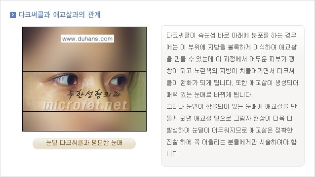 [두한성형외과 무한 경쟁력 눈밑성형] - [애교살 시술 1.] 관련 이미지 3