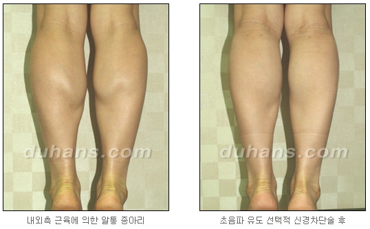 [Duhan Plastic Surgery Calf Reduction] - [How to Get Rid of Calf Muscle Bulges] image 17