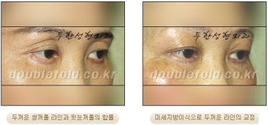 [두한성형외과 쌍커풀수술] - [쌍꺼풀지방이식] 관련 이미지 20