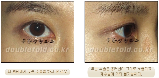 Best Place for Revision Eyelid Surgery, Duhan Plastic Surgery - Lowering Double Eyelid Line image 13